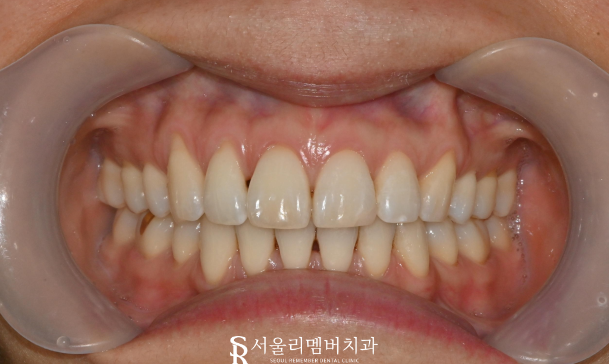 운동하다가 앞니 부러짐, 보라매 치과 에서 레진 치료 과정 관련 이미지 2