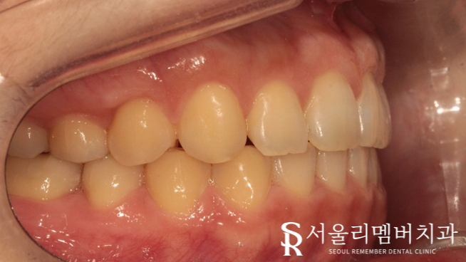 과개교합, 외적인 문제는 물론이며 기능 회복까지 개선하는 것이 중요합니다. 신대방치과 치아교정 관련 이미지 7