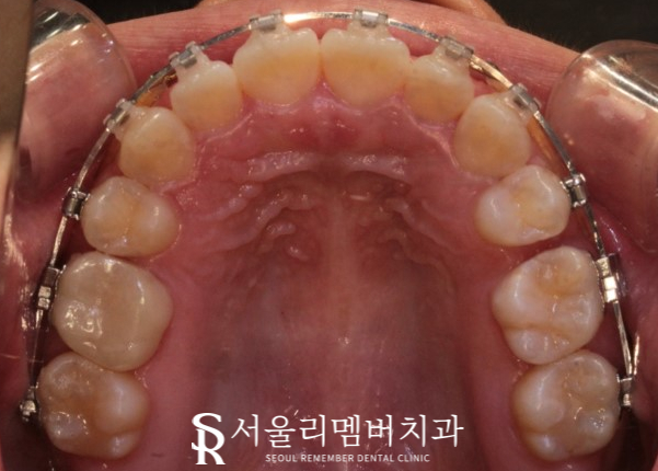 서울대입구역 치과 툭 튀어나온 돌출 때문에 발치교정 진행 관련 이미지 6