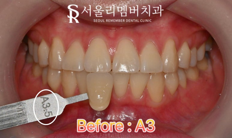 신림 치과 웨딩촬영 결혼 행사 앞두고 신경 쓰이는 누런 치아 하루 만에 밝게 만들 수 있을까? 관련 이미지 2