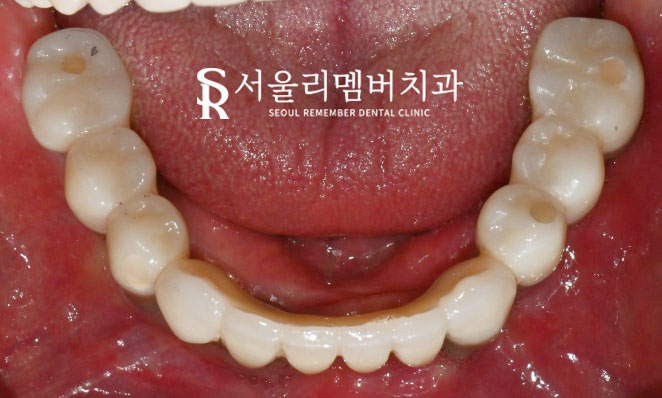 서울대입구역 치과 , 잇몸뼈 부족해도 전체 임플란트 ? 가능합니다. <증례 有> 관련 이미지 6