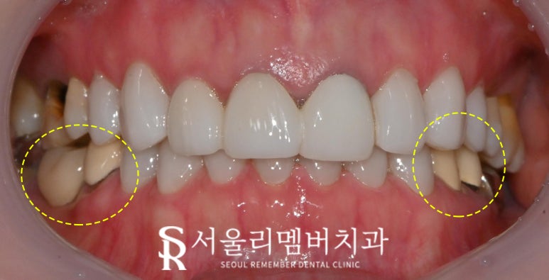 서울대입구역 치과 에서 오래된 어금니 브릿지 지르코니아 크라운 으로 교체해서 심미성 되찾아드렸습니다. 관련 이미지 2