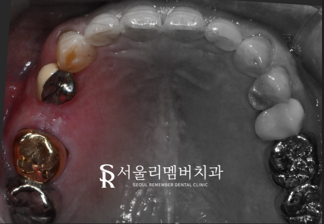 신길동 치과 임플란트에 대한 여러 소문들, 과연 사실일까? 관련 이미지 1