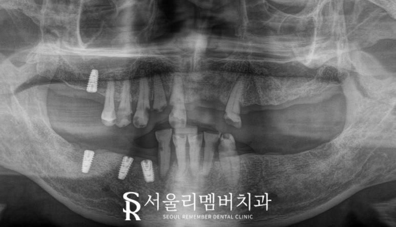 서울대입구역 치과 에서 안전하고 신속 정확하게 발치 후 전악 임플란트 식립한 케이스 관련 이미지 4