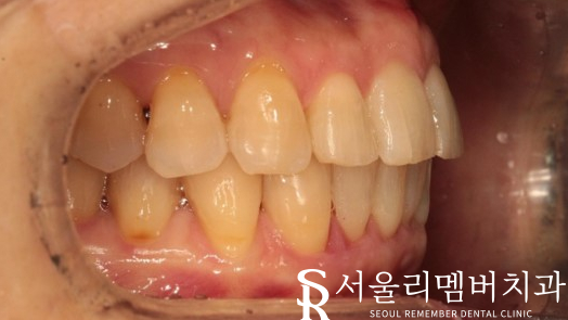 40대 교정 지금 시작해도 늦지 않을까요? 서울대입구역 치과 관련 이미지 11