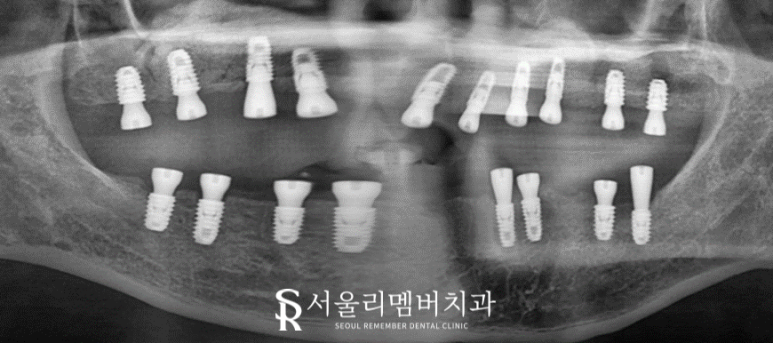 서울대입구역 치과 무너진 수직 고경 어떻게 개선했을까? 관련 이미지 6