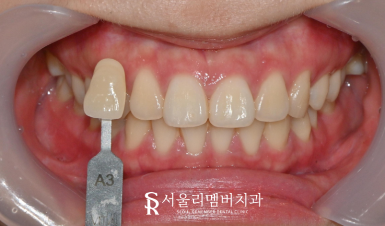 서울대입구역치과 치아미백으로 누런 치아를 얼마나 개선할 수 있을까요? 관련 이미지 1