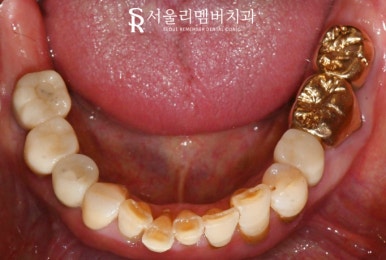 사당역 치과 충치, 치아 흔들림, 파절, 결손, 염증.. 다수의 복합 문제 생겼다면 임플란트 신경치료 크라운 과정 관련 이미지 8