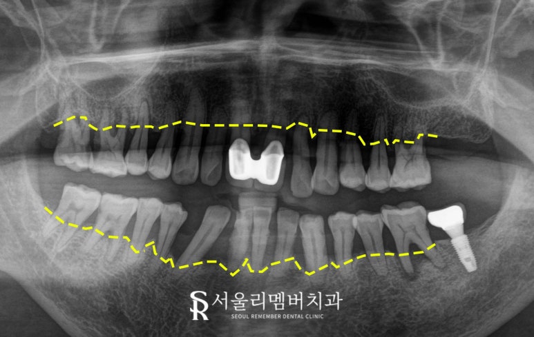서울대입구역 치과 잇몸이 내려앉아서 고민이라면 전악 임플란트로 해결 관련 이미지 2