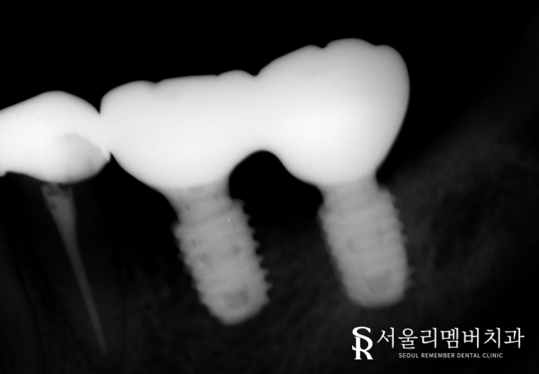 기존 브릿지 주변이 욱신거리고 아파요.. 왜 그런 걸까요? 신대방 치과 임플란트 증례 관련 이미지 3