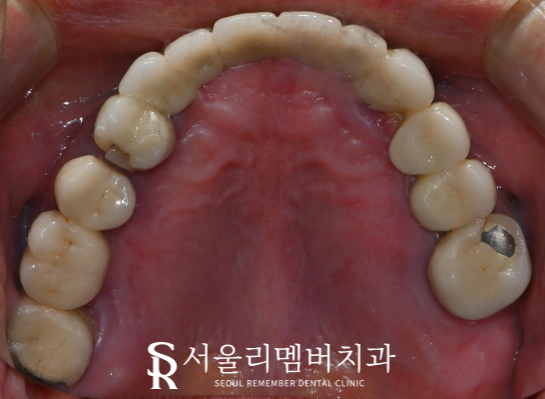 오래된 전체 브릿지 방치하면 이런 문제를 일으킬 수 있습니다. 서울대입구역 치과 풀케이스 치료 과정 관련 이미지 3