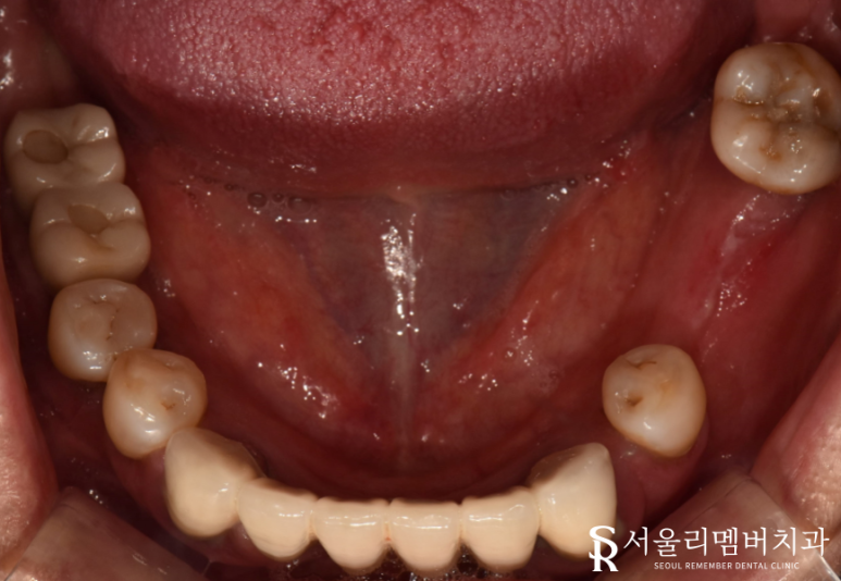 빠져버린 치아 그대로 내버려 두면 안모변형을 초래할 수 있습니다! 신림역 서울 리멤버 치과 관련 이미지 3