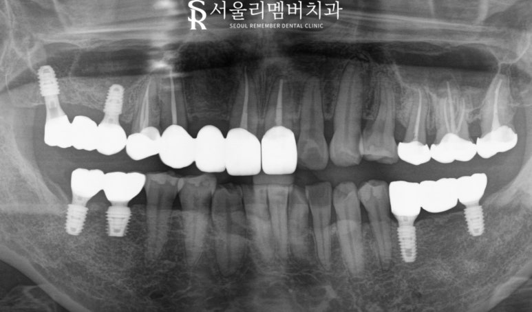 낙성대 치과 "어금니가 없어요." 가이드 임플란트와 신경치료 과정 관련 이미지 9