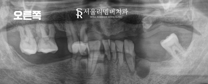 여러 곳이 결손된 치아 서울대입구역 치과 에서 다수 임플란트 식립으로 불편감을 개선해 드린 케이스 관련 이미지 4