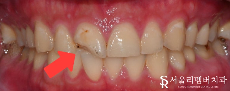 사당동 치과 에서 외상으로 인한 앞니 파절, 심미보철로 개선해 드렸습니다. 관련 이미지 1