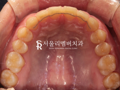 과개교합, 외적인 문제는 물론이며 기능 회복까지 개선하는 것이 중요합니다. 신대방치과 치아교정 관련 이미지 8