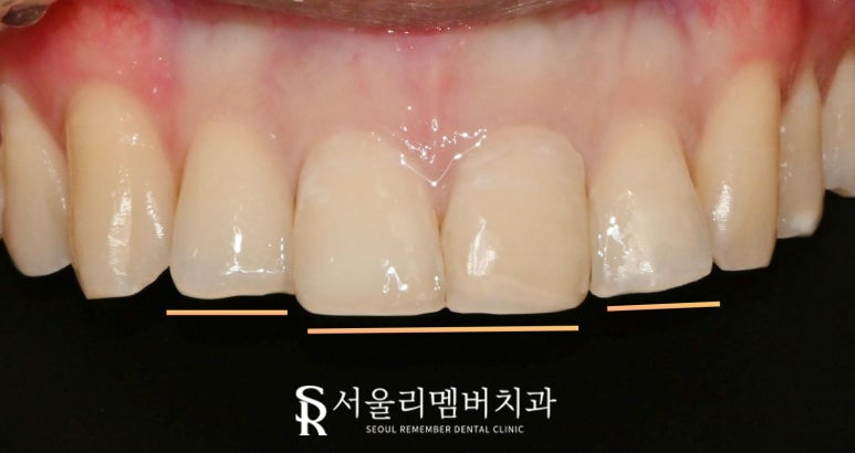 신림 치과 깨지고 길이 안 맞는 앞니 부러진 부분만 레진으로 간단하게 당일 치료 관련 이미지 5