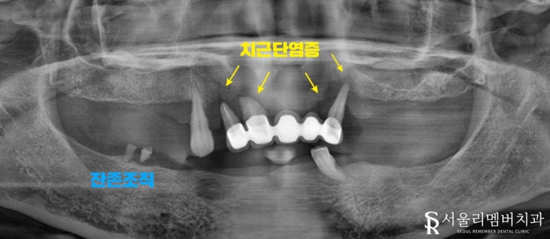 텅텅 여기저기 빠져버린 치아들, 이젠 음식을 씹을 수도 없어요.. 어떡하죠? 서울대입구역 리멤버 치과 관련 이미지 1