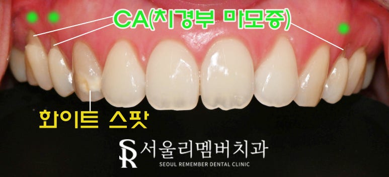 치아의 하얀 반점(화이트 스팟 white spot) 서울대입구역 치과 아이콘 레진으로 무삭제 반점치 충치 치료 관련 이미지 7