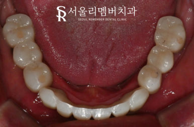 전체 보철을 할 수 밖에 없었던 이유, 서울대입구역 치과 교합 되살리기 관련 이미지 8
