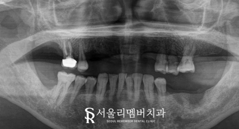 신림역 치과 임플란트 식립 시 어떤 것을 우선적으로 고려하는 것이 좋을까? 관련 이미지 2