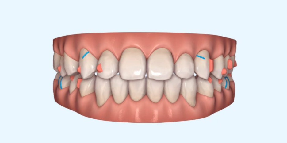 벌어진 치아, 사당 치과 인비절라인으로 개선할 수 있을까? 관련 이미지 7