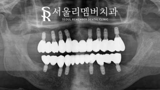 전체 보철을 할 수 밖에 없었던 이유, 서울대입구역 치과 교합 되살리기 관련 이미지 5