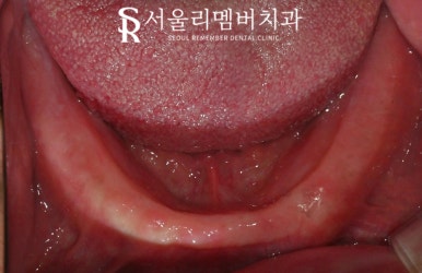 보라매 치과 에서 틀니에서 수면마취 전악 임플란트로 전체 치아 기능 회복 관련 이미지 3