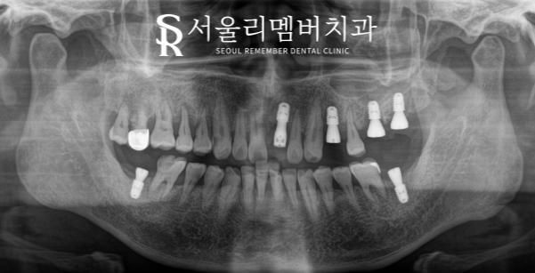 '임플란트 식립 시 뼈이식이 꼭 필요한 상황은?' 서울대입구역치과 관련 이미지 2