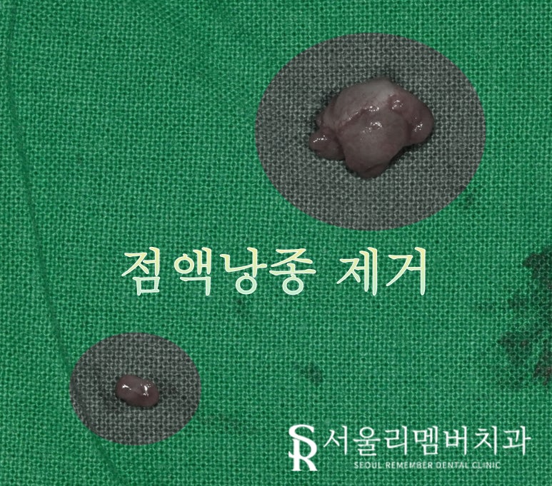 입술에 생긴 볼록한 혹? 관악구 치과 점액낭종(Mucocele) 진단과 제거 치료 방법 관련 이미지 3