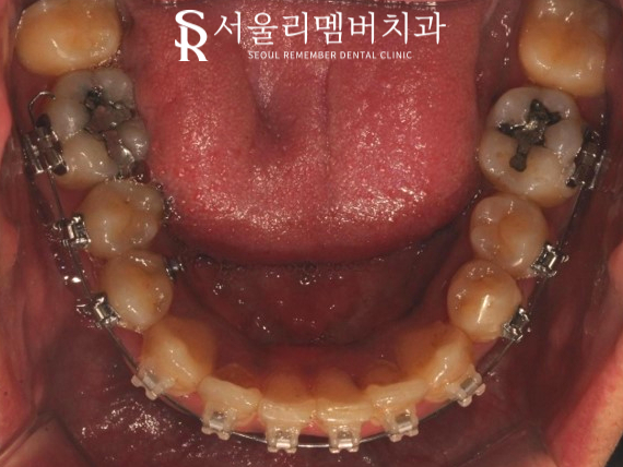 서울대입구역 치과 에서 들쑥날쑥 했던 치열, 비발치로 개선해 드렸습니다. 관련 이미지 6