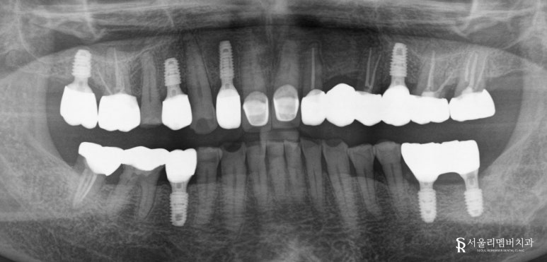 낙성대 치과 다수 상실된 치아 가이드 임플란트 식립으로 정확하고 튼튼한 치료 후기 관련 이미지 3
