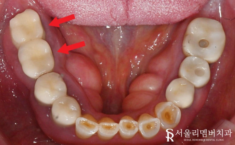 사당역 치과 임플란트 주위 염증으로 픽스처 제거 후 다시 식립 재수술 필요하다면? 관련 이미지 2