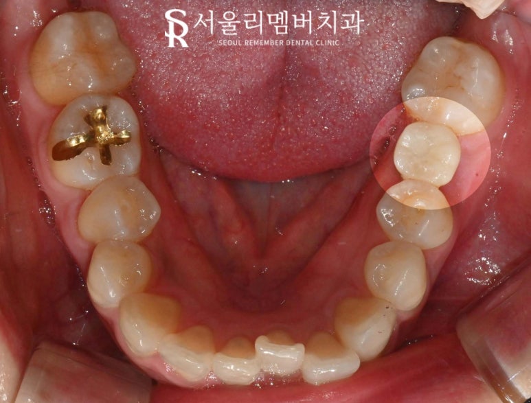 상실된 작은 어금니와 사랑니가 있을 때, 사당 치과 임플란트 및 안전한 발치 과정은? 관련 이미지 4
