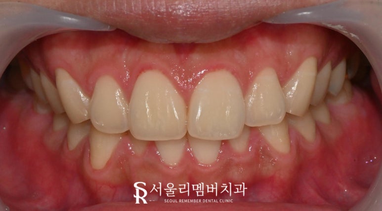 신대방 치과 치아미백 잘하는 곳 추천, 오래 유지하려면 어떻게 해야 되나요? 관련 이미지 1