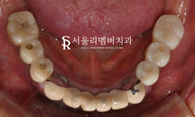서울대입구역치과 수면마취를 사용한 전체 임플란트 식립 과정 관련 이미지 8