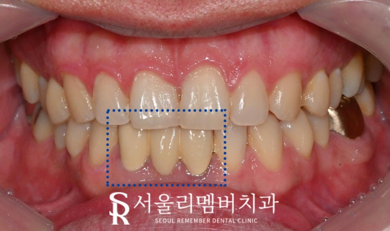 서울대입구 치과 아래 앞니 하악 전치부 브릿지에서 임플란트로 바꿀 수 있나요? 관련 이미지 2