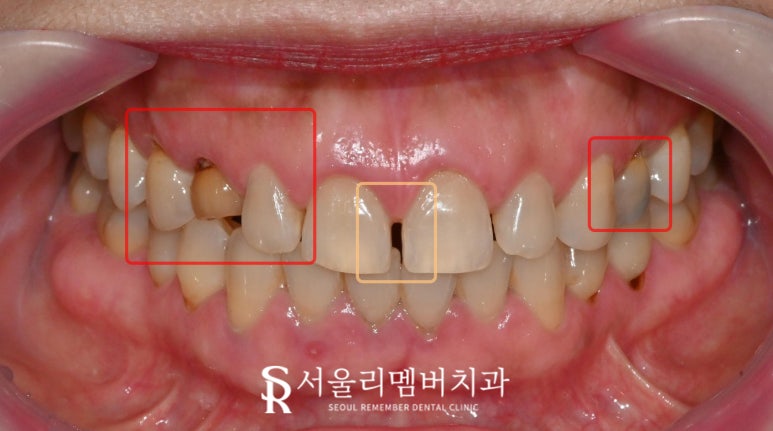 서울대입구 치과 에서 앞니 벌어짐, 변색, 부러지고 통증 있는 치아 레진과 크라운으로 심미 치료 해드린 사례 관련 이미지 1