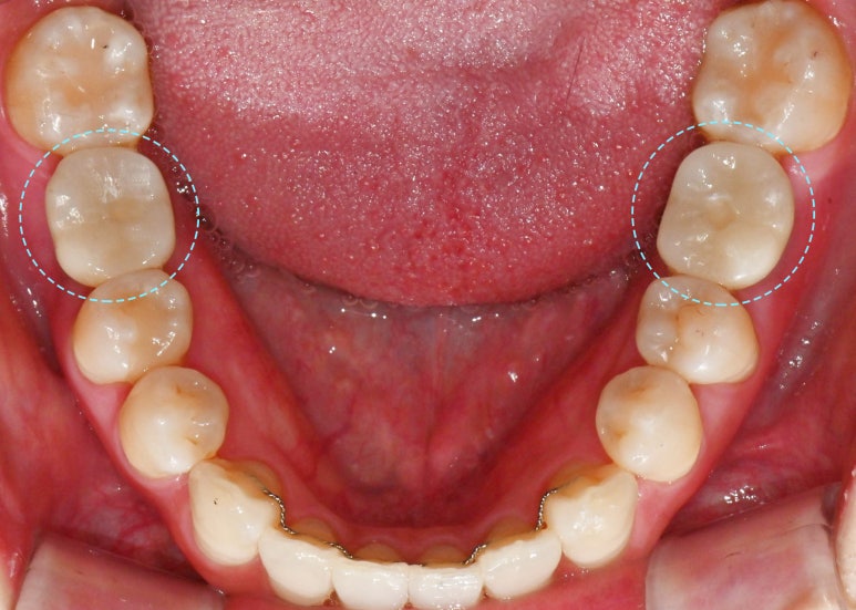 선천적 영구치 결손으로 남아있는 만기 잔존 유치, 서울대입구역 교정 치과 에서 투명 인비절라인 & 임플란트 케이스 관련 이미지 9