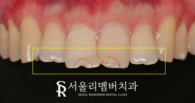 신림 치과 깨지고 길이 안 맞는 앞니 부러진 부분만 레진으로 간단하게 당일 치료 관련 이미지 1