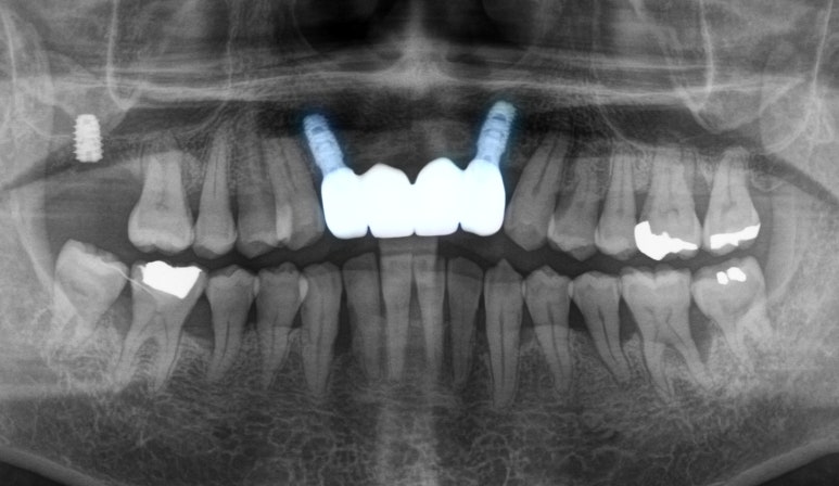 보라매 치과 삐뚤어진 교합 불량 앞니, 임플란트로 가지런하게 만들어드린 사례 관련 이미지 5
