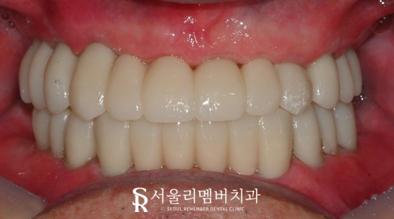 보라매 치과 에서 틀니에서 수면마취 전악 임플란트로 전체 치아 기능 회복 관련 이미지 8