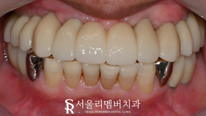 올바른 교합의 중요성, 서울대입구역치과 전체 임플란트 기간 및 과정 관련 이미지 5