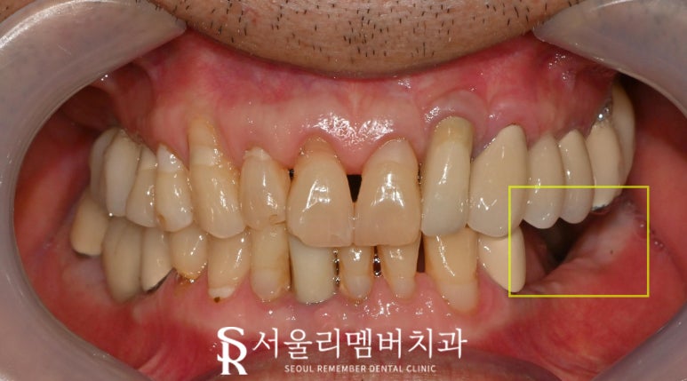 왼쪽 아래 어금니 임플란트 브릿지 장점, 진행 과정, 빨리 치료해야 되는 이유 상도동 치과 관련 이미지 1