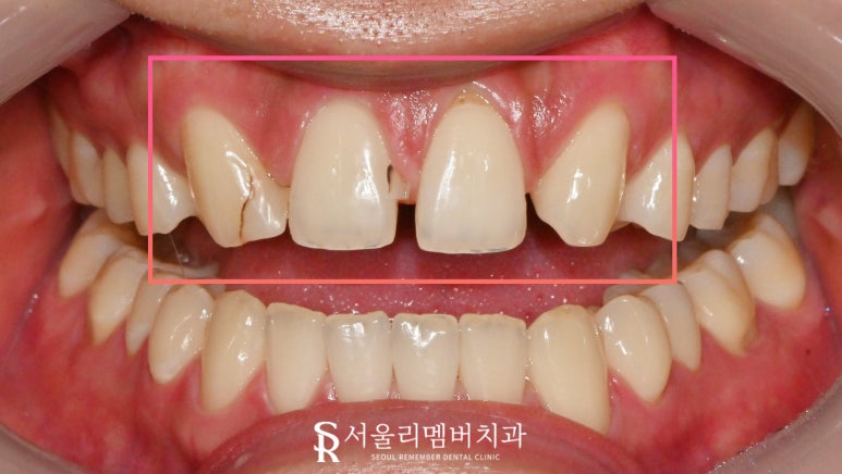 서울대입구 치과 결손된 앞니 자연스러운 라미 리얼네이트로 변색 레진과 사이 공간 막을 수 있다면 관련 이미지 2