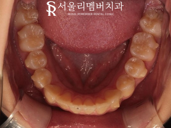 인비절라인을 사용한 치아 총생 개선 증례! 청룡동 치과 관련 이미지 10