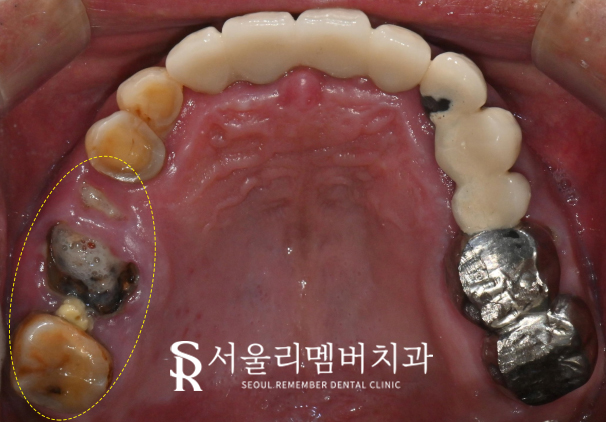 야간 진료 가능한 서울대입구역 치과 에서 퇴근 후에도 임플란트 하실 수 있습니다. 관련 이미지 1