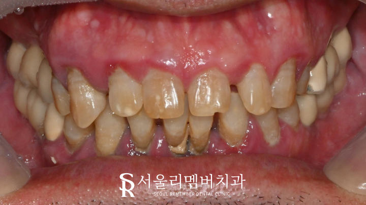 색이 변하고 약해진 치아들, 서울대입구역치과 에서 앞니 보철 수복으로 개선을 도와드렸습니다. 관련 이미지 1