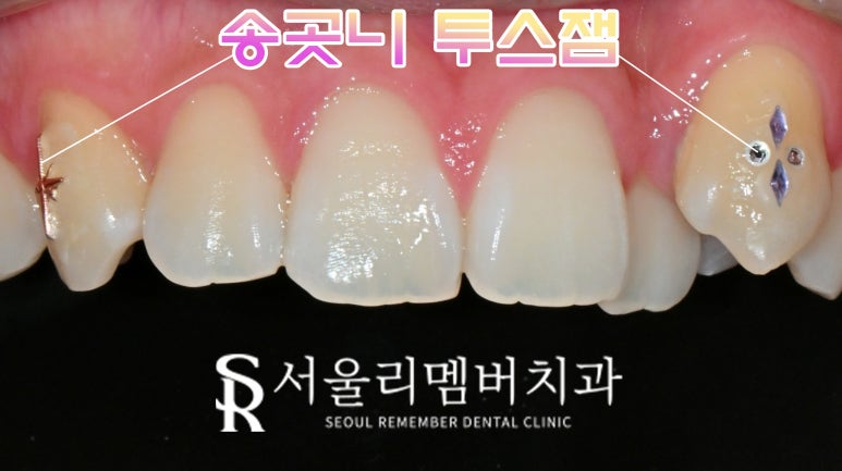 상도동 치과 송곳니 투스잼과 잔여 레진, 안전하고 스크래치 기스 흠집 없이 당일 제거할 수 있을까? 관련 이미지 1
