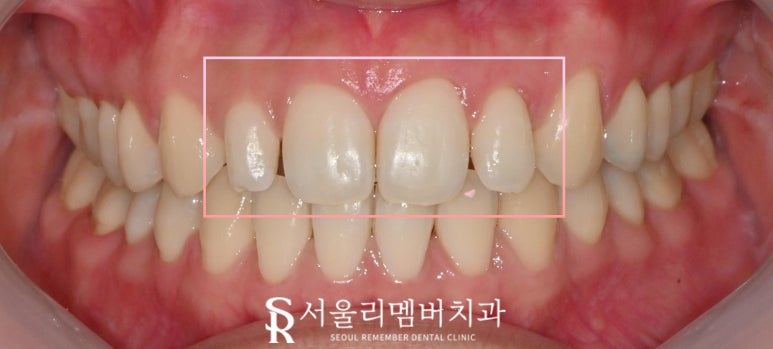 치아 크기 작은 왜소 측절치, 봉천동 치과 전치부 라미네이트로 자연치 삭제 없이 리얼하게 개선하는 방법 관련 이미지 2